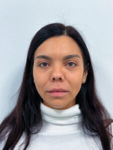 Нижняя блефаропластика - после