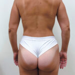 Бодилифт - после