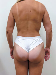 Бодилифт - после