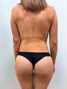 Бодилифтинг - после