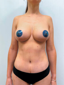 Маммопластика подтяжка + бодилифт - после