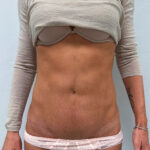 Липоабдоминопластика - после