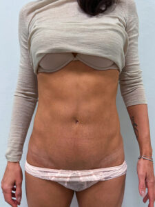 Липоабдоминопластика - после