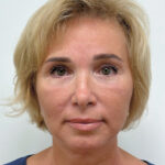 Тотальное омоложение лица - после