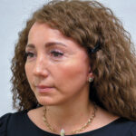 Тотальное омоложение лица - после