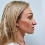 Тотальное омоложение лица - после