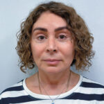 Тотальное омоложение лица - после