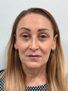 Эндоскопический лифтинг в сочетании блефаропластикой - после