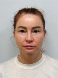 Эндоскопический лифтинг в сочетании блефаропластикой - после