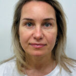 Эндоскопический лифтинг в сочетании блефаропластикой - после