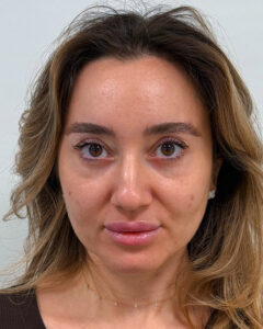 Эндоскопический лифтинг с нижней блефаропластикой - после