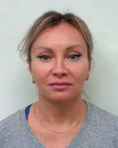 Комплексное омоложение лица - после