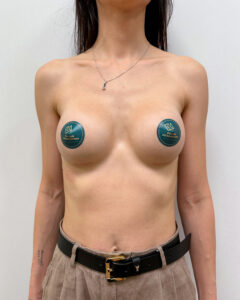 Маммопластика увеличение - после