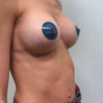 Маммопластика увеличение - после