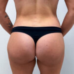 Липофилинг ягодиц - после