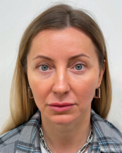 Трансконъюнктивальная блефаропластика - после