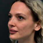 Ринопластика - после