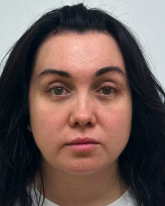 Эндоскопический лифтинг с блефаропластикой - после