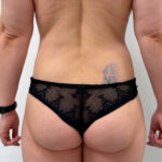 Липосакция - после