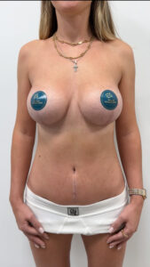 Увеличение с подтяжкой - после