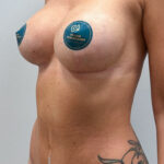 Комплексная операция грудь + живот - после