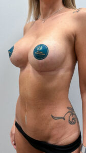 Комплексная операция грудь + живот - после