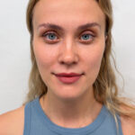 Трансконъюнктивальная + верхняя блефаропластика - после