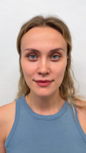 Трансконъюнктивальная + верхняя блефаропластика - после