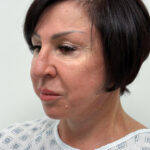 Комплексная операция на лице - после