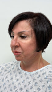 Комплексная операция на лице - после