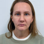 Эндоскопический лифтинг + круговая блефаропластика - после