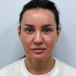 Круговая блефаропластика + эндоскопический лифтинг - после