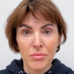 Трансконъюнктивальная блефаропластика - после