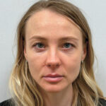 Трансконъюнктивальная блефаропластика - после