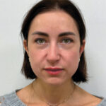 Эндоскопический лифтинг в сочетании с круговой блефаропластикой - после