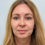 Эндоскопический лифтинг в сочетании с круговой блефаропластикой - после