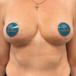 Редукционная маммопластика с подтяжкой без имплантации - после