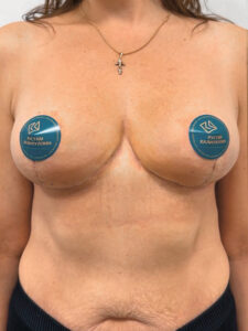 Редукционная маммопластика с подтяжкой без имплантации - после
