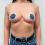 Редукционная маммопластика с подтяжкой без имплантации - после