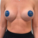 Подтяжка с увеличением - после