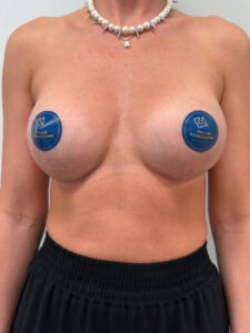 Подтяжка с увеличением - после