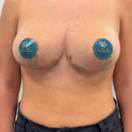 Редукционная маммопластика с подтяжкой без имплантации - после