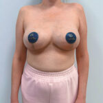 Редукционная маммопластика с подтяжкой без имплантации - после