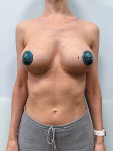 Реэндопротезирование - после