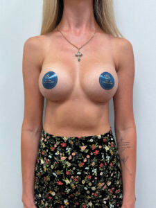 Маммопластика увеличение - после