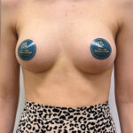 Маммопластика увеличение - после