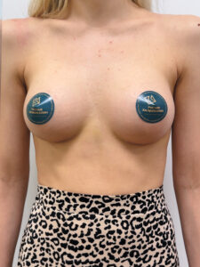 Маммопластика увеличение - после