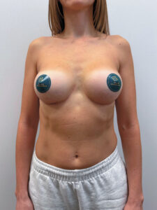 Маммопластика увеличение - после