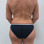 Липосакция - после