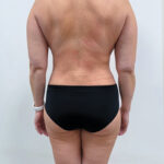 Липосакция - после